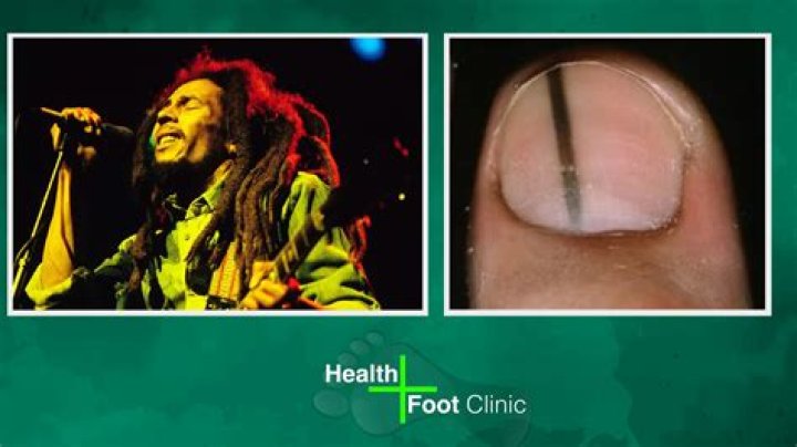 Did Bob Marley Have His Toe Removed? Uncovering the Legend