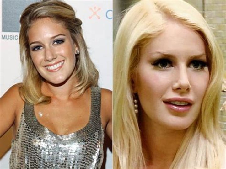 Heidi Montag: A Transformation Story from Before to After Surgery