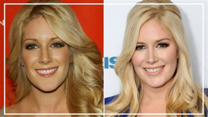 Heidi Montag's Transformation: Before and After Plastic Surgery