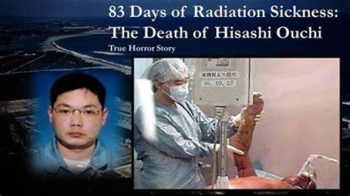 Hisashi Ouchi: The Real Body and The Tragic Story Behind It