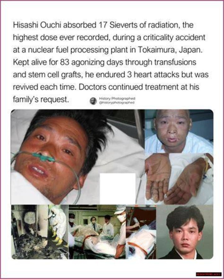 Hisashi Ouchi: The Tragic Tale of a Nuclear Accident Survivor