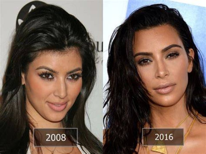Kim Kardashian Rhinoplasty: The Journey, Impact, and Everything You Need to Know